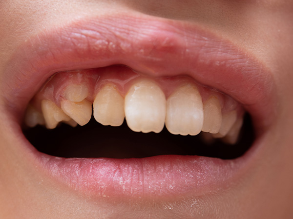 永久歯が生えてきたのに抜けない乳歯の抜歯