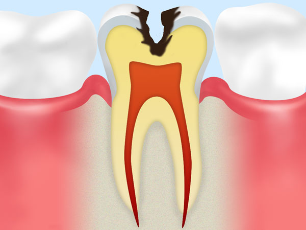 象牙質の虫歯（C2）