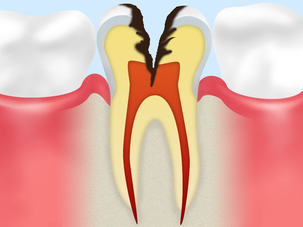 神経に達した虫歯（C3）