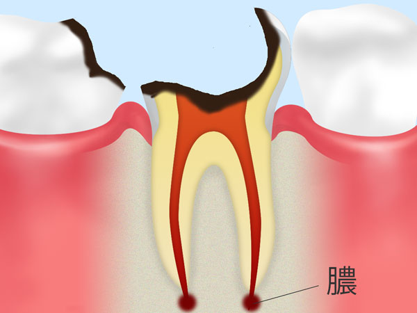 歯根に達した虫歯（C4）