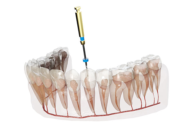 重度の虫歯でも歯を残せる根管治療