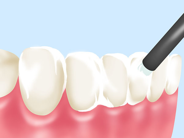 歯科衛生士から患者さんへ～治療後のメインテナンスが大切です～