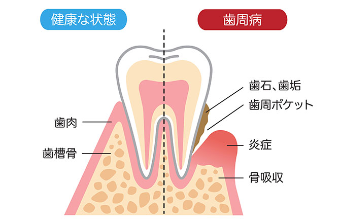 歯周病は静かに進行し歯が失われる怖い病気