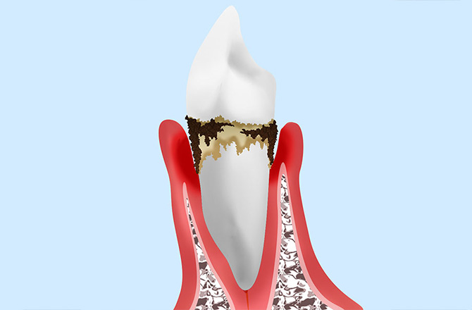 中等度の歯周炎