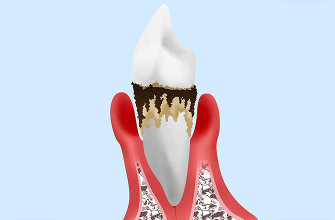 重度の歯周炎